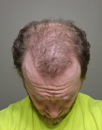 Hair Transplants: Case 7 - Hairline and Midscalp Restoration - 5 Month Result