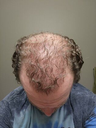 Hair Transplants: Case 7 - Hairline and Midscalp Restoration - 6 Month Result