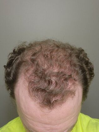 Hair Transplants: Case 7 - Hairline and Midscalp Restoration - 7 Month Result