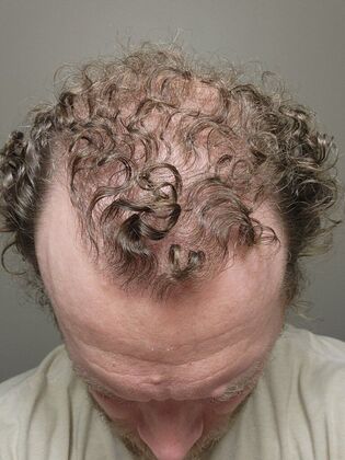 Hair Transplants: Case 7 - Hairline and Midscalp Restoration - 9 Month Result