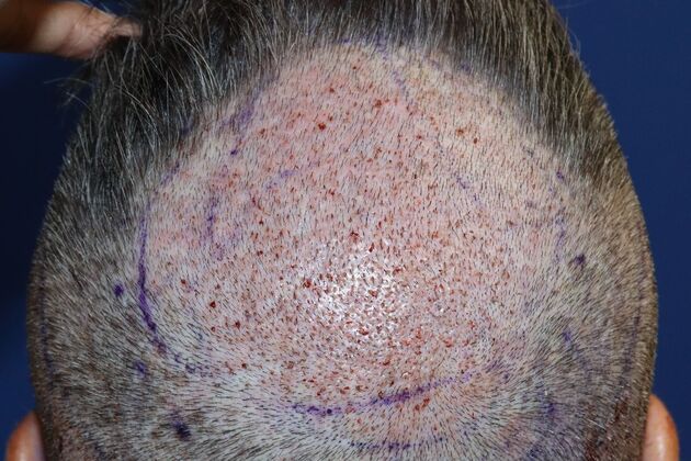 Hair Transplants: Case 8 - Crown FUE Transplant - Immediate Post-Op