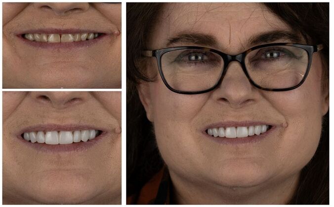 Veneers Case 1