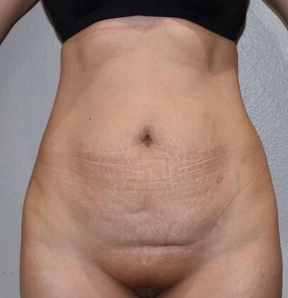 Tummy Tuck (Abdominoplasty) Case 527 - Before