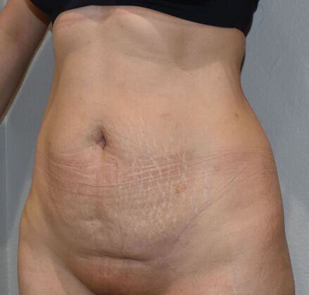 Tummy Tuck (Abdominoplasty): Case 527 - Before