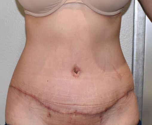 Tummy Tuck (Abdominoplasty) Case 527 - After