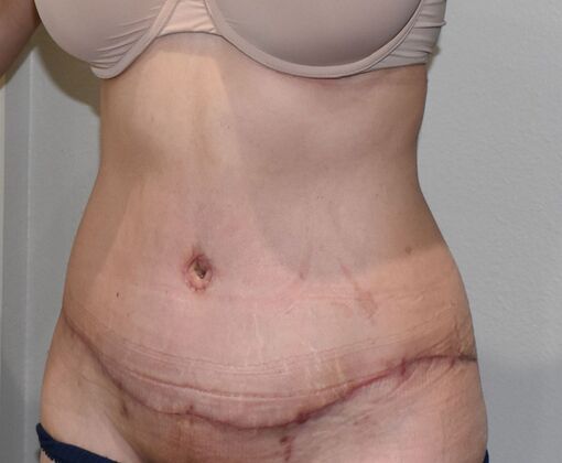 Tummy Tuck (Abdominoplasty): Case 527 - After