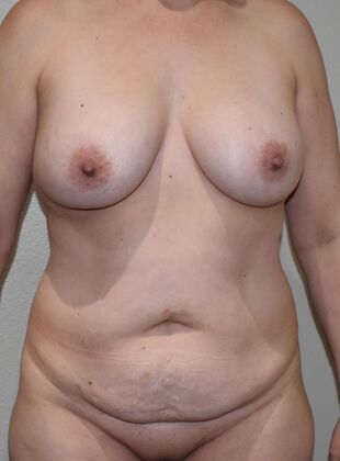 Mommy Makeover Case 335 - Before