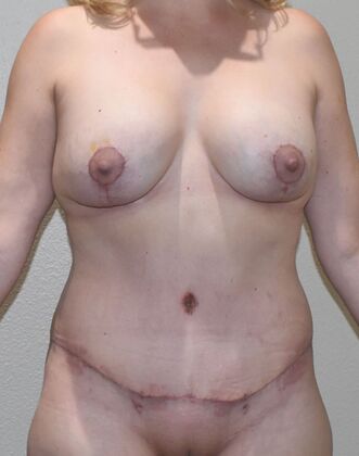 Mommy Makeover Case 335 - After