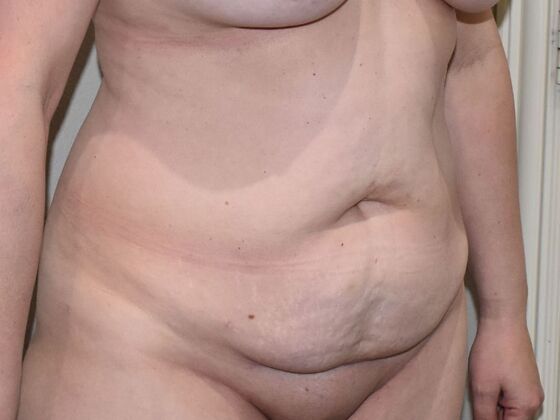 Tummy Tuck (Abdominoplasty): Case 528 - Before