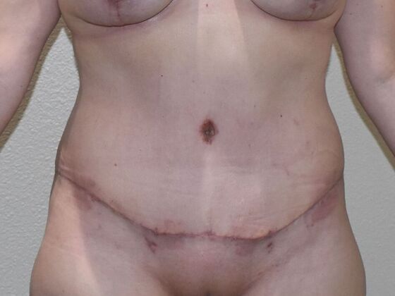 Tummy Tuck (Abdominoplasty) Case 528 - After