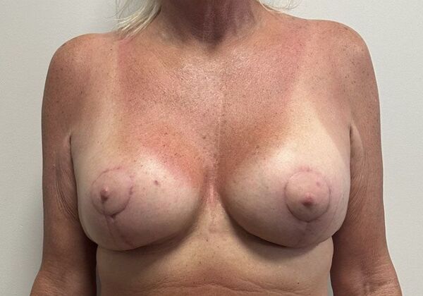 Breast Augmentation w/ Lift: Case 585 - After