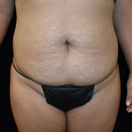 Abdominoplasty Case 26 - Before