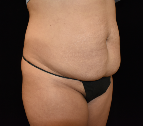 Abdominoplasty: Case 26 - Before