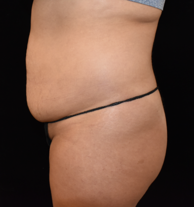 Abdominoplasty: Case 26 - Before