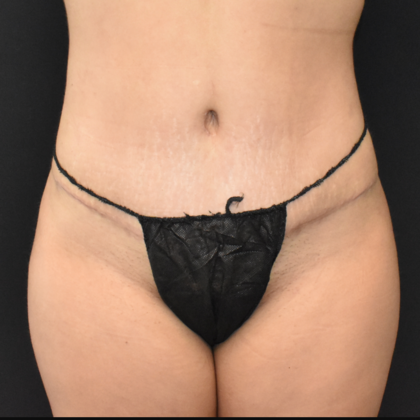 Abdominoplasty Case 26 - After