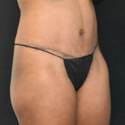 Abdominoplasty: Case 27 - After