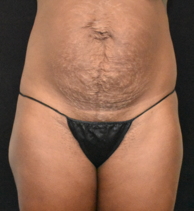 Abdominoplasty Case 27 - Before