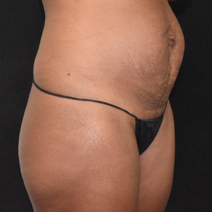 Abdominoplasty: Case 27 - Before