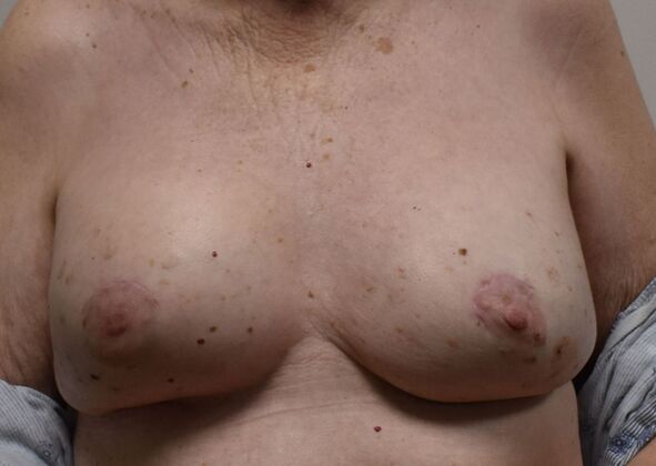 Breast Revision: Case 285 - After