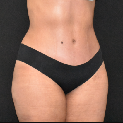 Abdominoplasty: Case 28 - After