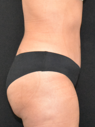 Abdominoplasty: Case 28 - After