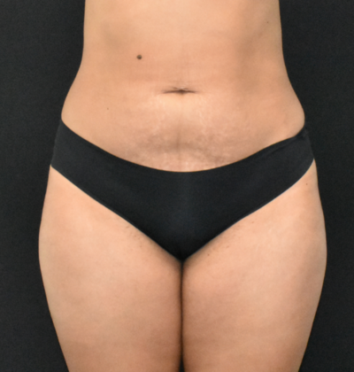 Abdominoplasty Case 28 - Before