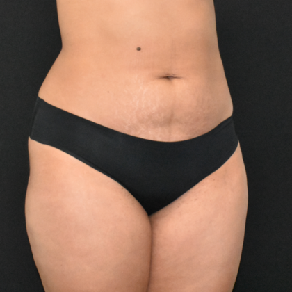 Abdominoplasty: Case 28 - Before
