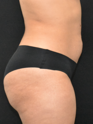 Abdominoplasty: Case 28 - Before