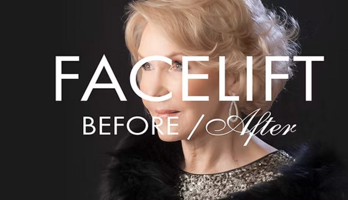 Facelift Cases