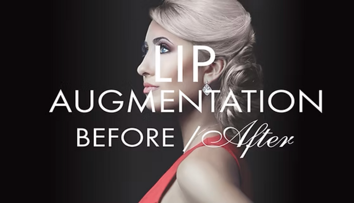 Lip Augmentation Cases