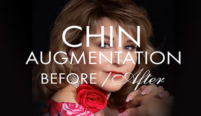 Chin Augmentation/Implant Cases