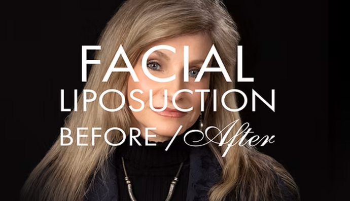 Facial Liposuction Cases