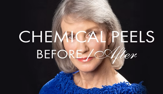 Chemical Peels Cases