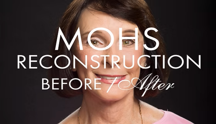 MOHS Reconstruction Cases