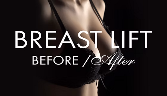 Breast Lift Cases