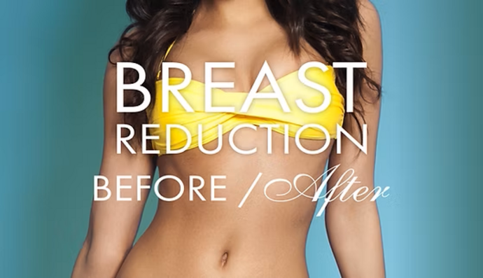 Breast Reduction Cases