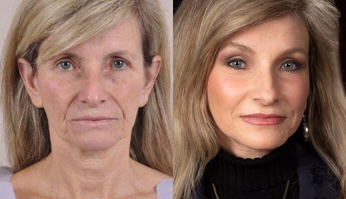 Brow Lift: Case 2 - Before and After