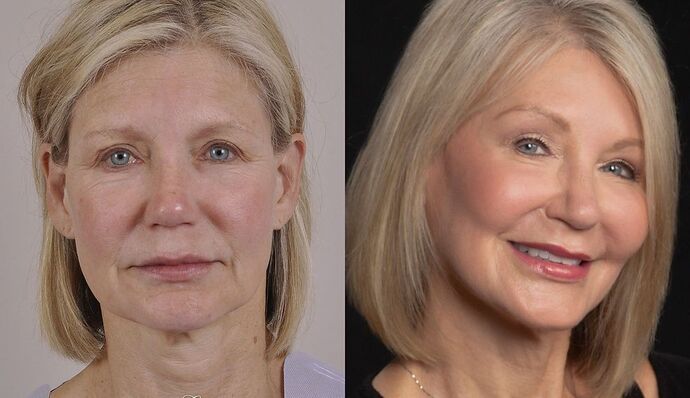 Brow Lift: Case 8 - Before and After