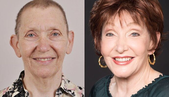 Brow Lift: Case 14 - Before and After