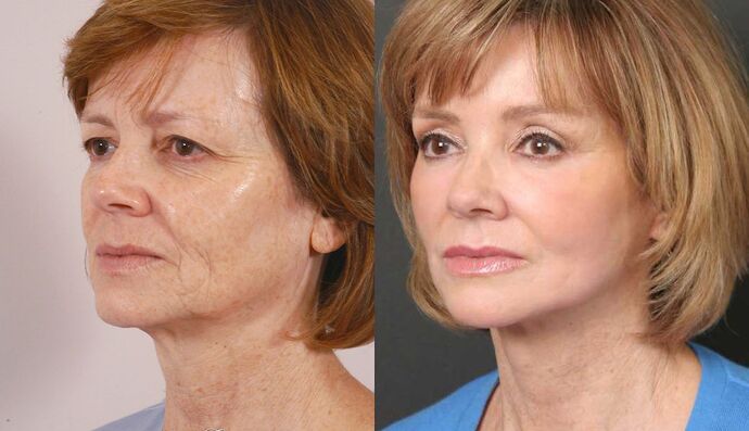 Brow Lift: Case 16 - Before and After