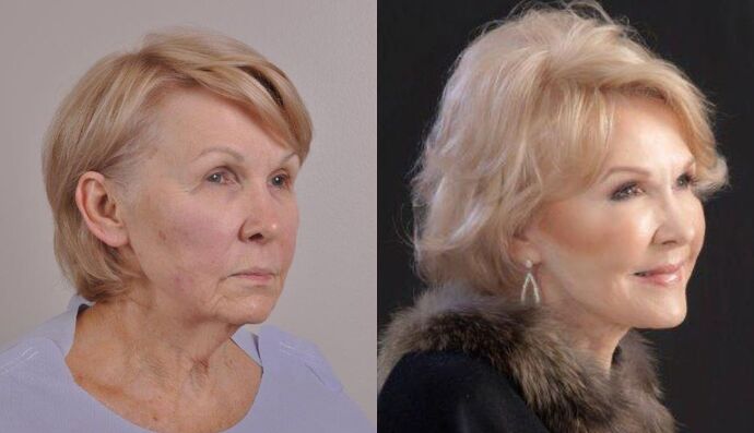 Brow Lift: Case 21 - Before and After