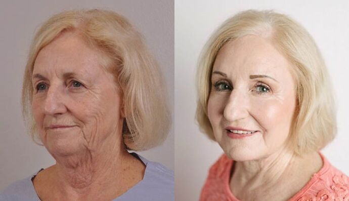 Eyelid Surgery: Case 2 - Before and After