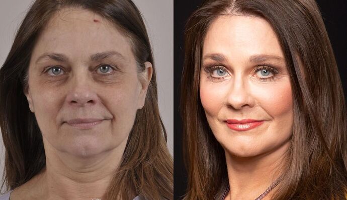 Eyelid Surgery: Case 4 - Before and After