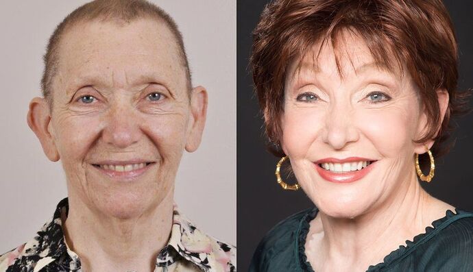 Eyelid Surgery: Case 5 - Before and After