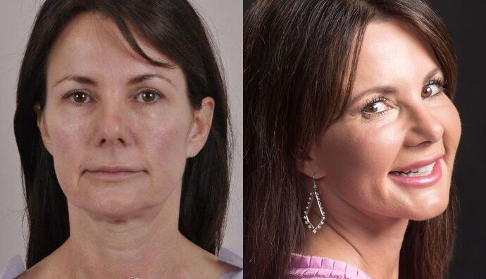 Eyelid Surgery: Case 6 - Before and After