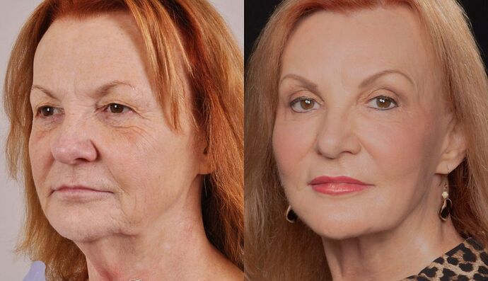 Eyelid Surgery: Case 11 - Before and After