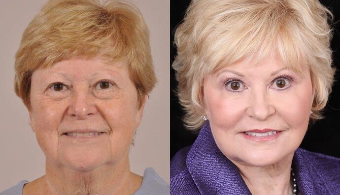 Eyelid Surgery: Case 13 - Before and After