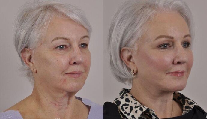 Eyelid Surgery: Case 14 - Before and After