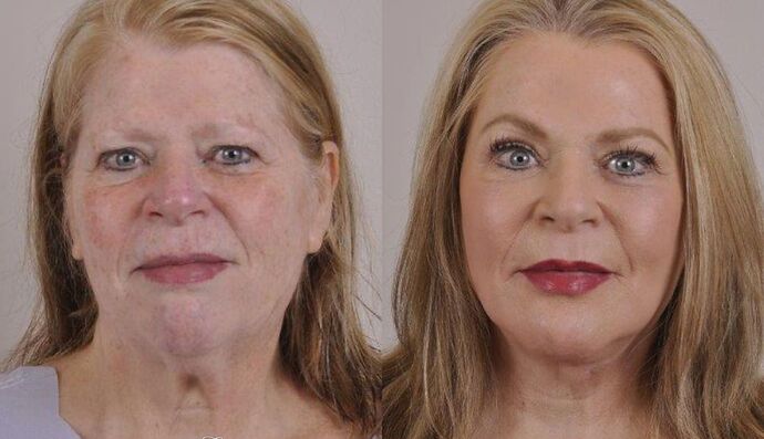 Eyelid Surgery: Case 15 - Before and After