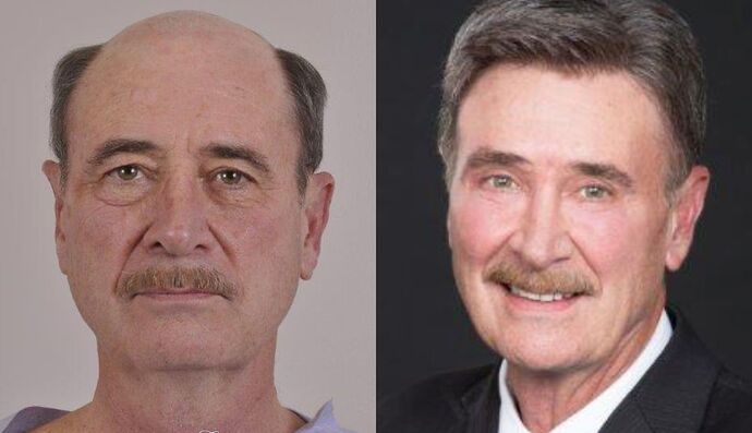 Eyelid Surgery: Case 16 - Before and After